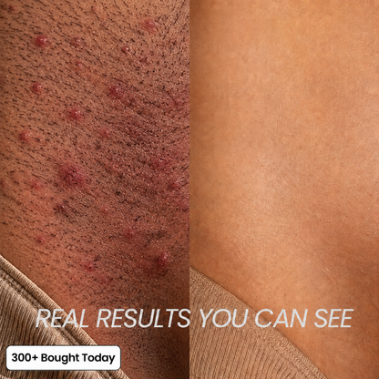 Cyperus Root Hair Reduction Oil